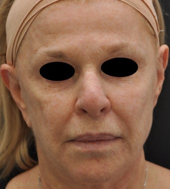 TCA Full-Face Chemical Peel before 182428