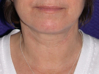 Necklift after 208443