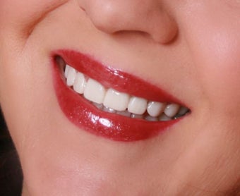 Temporary Veneers after 421768