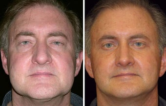 55 year old male, rhinoplasty before 629111