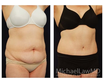 Abdominoplasty - Tummy Tuck after 396085