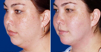 Chin Implant after 495866