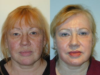 Trichloroacetic Acid Peel (TCA) and Upper Lid Blepharoplasty before 137730