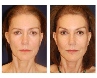 Cheek Augmentation after 415264