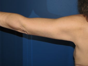 Brachioplasty 575816