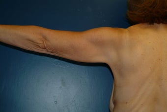 Brachioplasty 576423