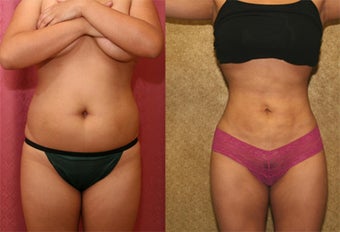 liposuction before 242930