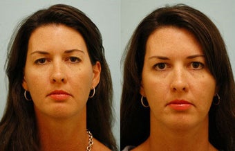 Botox before 138513