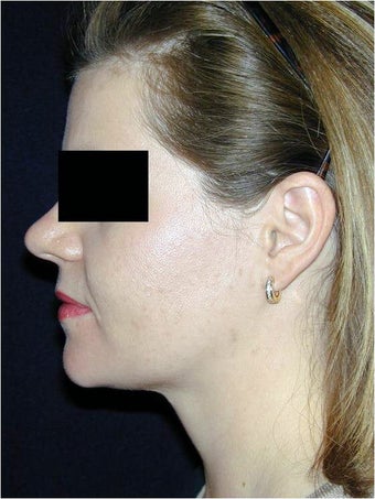Neck Liposculpture after 312661