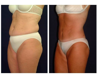 Tummy Tuck / Abdominoplasty before 55010