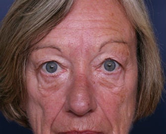 eyelid blepharoplasty before 378922