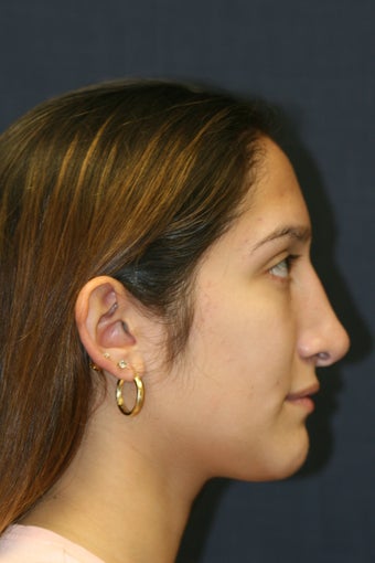 Rhinoplasty and Septoplasty 527291