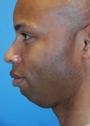 Chin implant before 199377