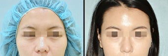 Rhinoplasty before 650753