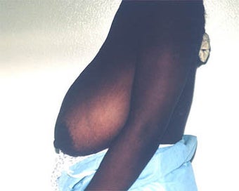 Breast Lift before 285338