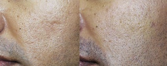 Acne Scar Treated with Sculptra before 182794