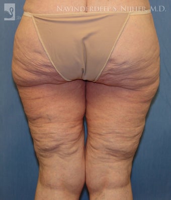 Backlift before 502540