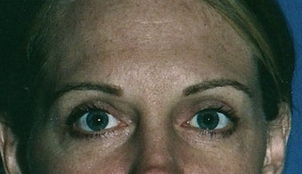 Upper and lower eyelid (blepharoplasty) Surgery after 283894