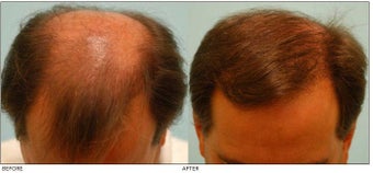 Hair Transplant before 134757