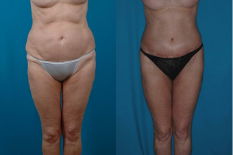 Thigh Lift before 574590