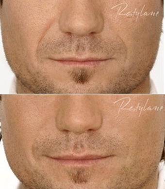 Restylane Male Nasolabial Folds Before After before 6285