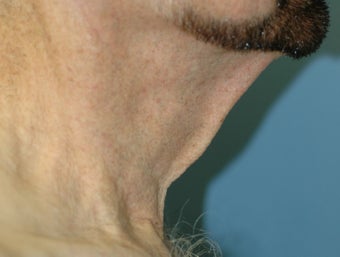 Neck Lift 537418