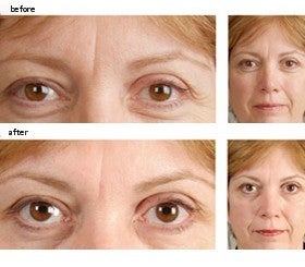 Botox for Frown Lines before 6316