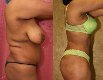 tummy tuck revision 302681
