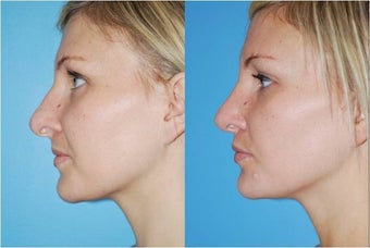 Rhinoplasty after 388996