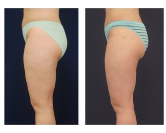 Liposuction 392328