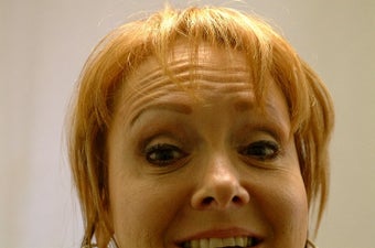 Botox before 411263