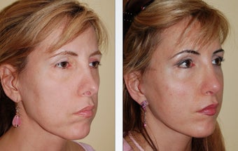 Revision Rhinoplasty after 359000