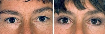Blepharoplasty before 643225
