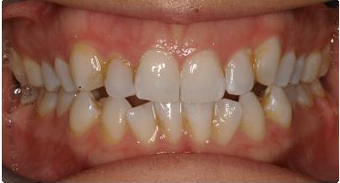 Orthodontic treatment without extraction of teeth 546583