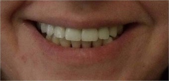 Smile Makeover with crowns and veneers after 367209