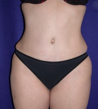 Tummy Tuck (abdominoplasty) after 208470