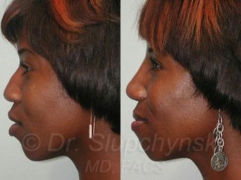 African American Rhinoplasty before 374006