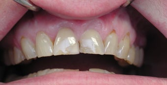 Gum lift (Crown Lengtheing), Root coverage with soft tissue Graft, 565879