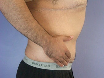 After Weight Loss Male Tummy Tuck after 280821