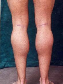 Men's Calf Augmentation after 519054