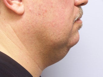 Chin/Neck Liposuction before 593084