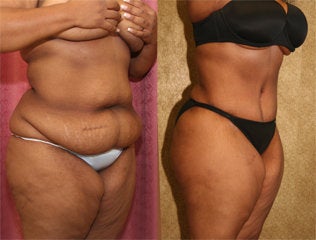 abdominoplasty before 232458