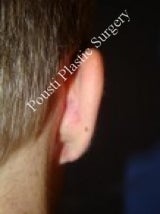 Earlobe Repair Surgery 612298