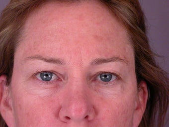 Eyelid Surgery before 306447