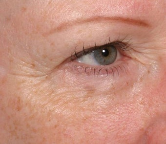 Resytlane under eyes before 137849
