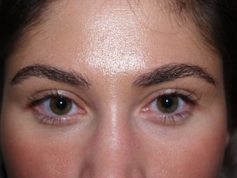 Eyebrow transplant after 174842