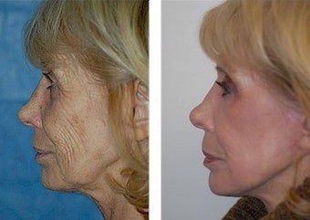 Mini-Facelift, CO2 Laser before 308133