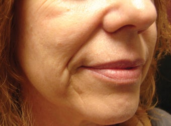 Radiesse Injection into the Cheeks and Nasolabial Folds before 257721