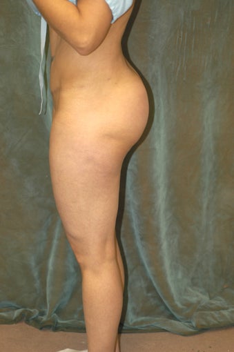 Butt Augmentation after 510793