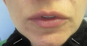 Radiesse Injection before 387859